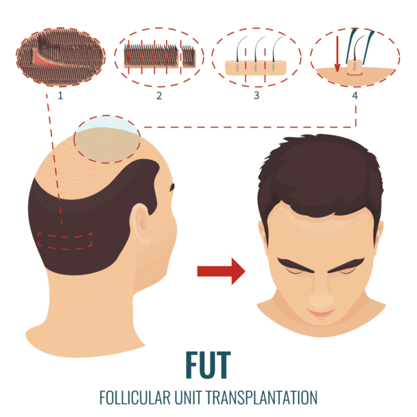 procedure of fut hair transplant