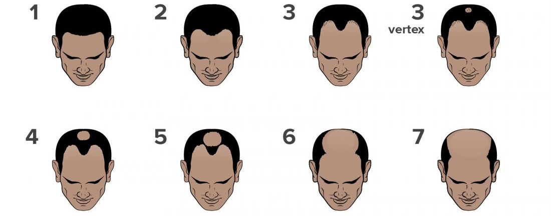 Hairloss Stages