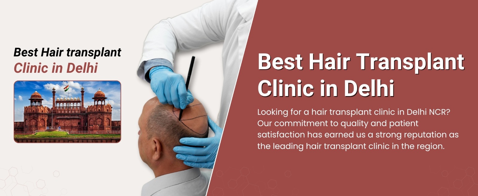 Best hair transplant clinic in Delhi