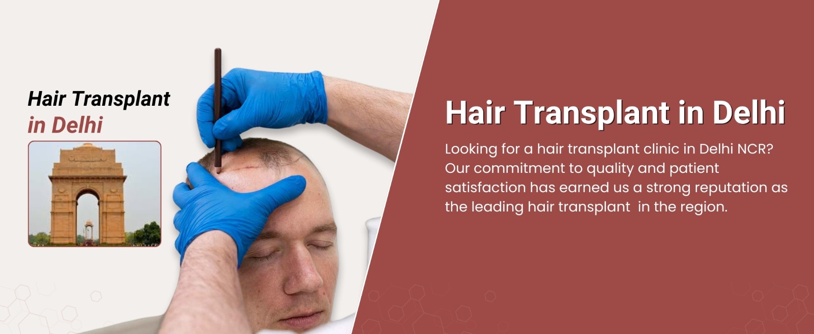 Hair transplant in Delhi