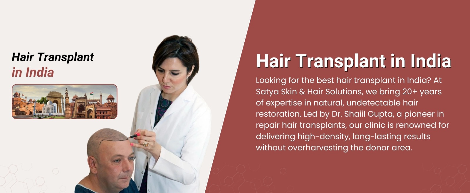 Hair Transplant In India